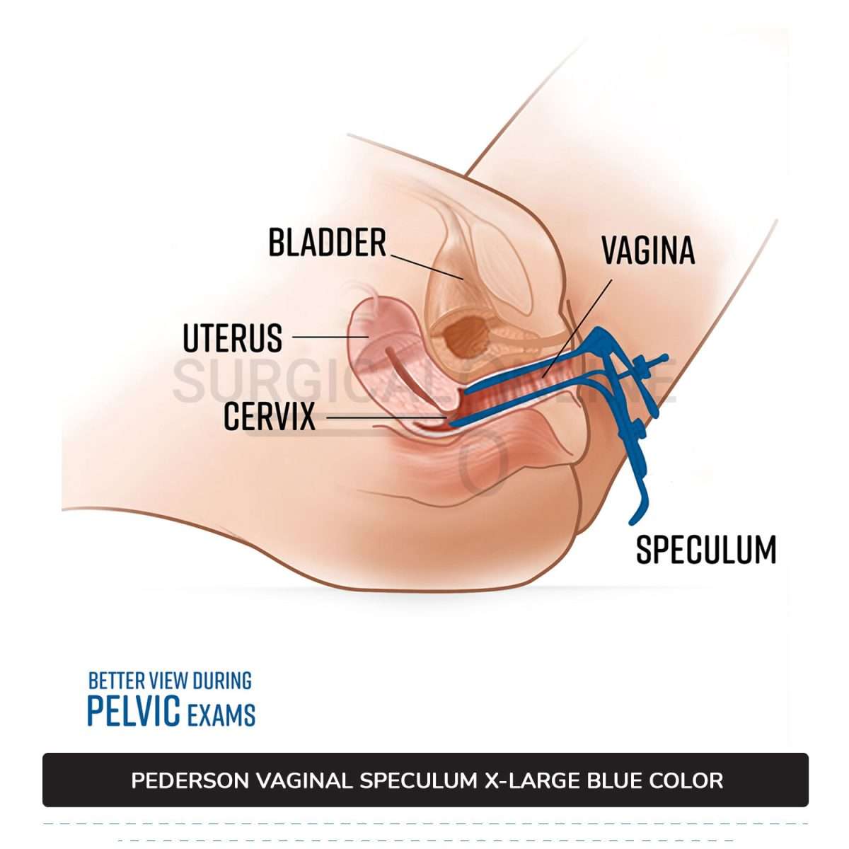 Set of 4 Pcs Pederson Vaginal Speculum LLETZ LEEP Blue Teflon Cover